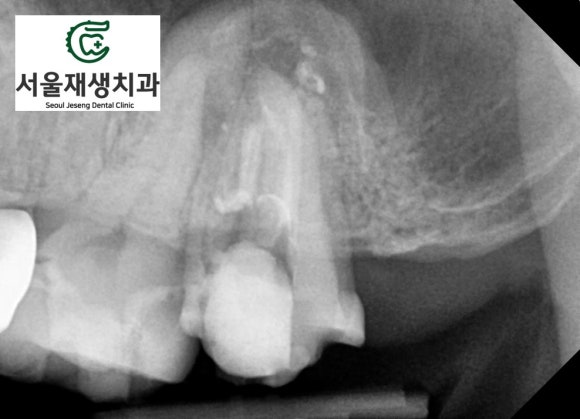 [재신경치료] 예전에 신경치료 한 치아가 갑자기 붓고 아파요! (현미경 신경치료, 서울재생치과) 관련 이미지 9