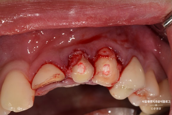 [치아외상] 부러진 앞니, 발치가 답인가요? (사고로 부러진 치아, 외과적정출술로 살리기) 관련 이미지 16