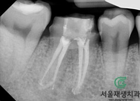 [재신경치료] 3년 전에 신경치료 했던 치아인데 다시 아파요! (미세 현미경 재신경치료, 서울재생치과) 관련 이미지 13