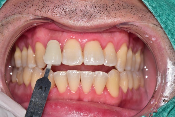 치과에서 미백치료를 받은 후에 치아에 하얀 반점이 생기고 얼룩덜룩해졌어요. 관련 이미지 4