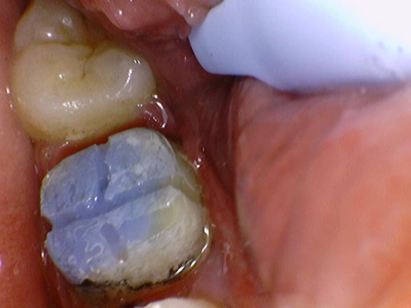 [재신경치료] 20대 남성, 9년 전에 신경치료한 치아에서 고름이 나와요. 관련 이미지 6