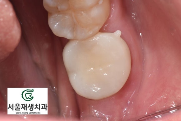 [재신경치료] 치과 종사자도 찾아오는 신경치료 전문치과, 서울재생치과! 관련 이미지 12