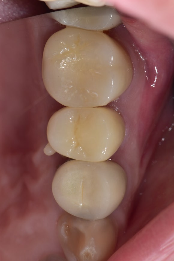 [재신경치료] 신경치료 받은 치아가 아프고 흔들려요 (ft. Zeiss미세현미경) 관련 이미지 5