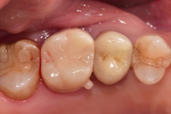 [치아살리기] 부러진 치아를 빼고 임플란트해야 한대요. 관련 이미지 8