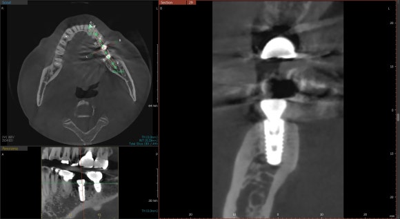 [임플란트] 재신경치료를 시도할 수 없을 때. 뼈이식 없는 임플란트 시술로 간편하게. 관련 이미지 9