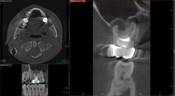 [재신경치료] 10년전에 한 신경치료가 뭔가 불편해요... 관련 이미지 4