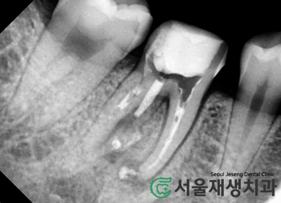 [재신경치료] 신경치료 받은 치아가 붓고 아파요! 현미경과 CT의 도움으로 다시 한 번 꼼꼼하게~ 관련 이미지 13