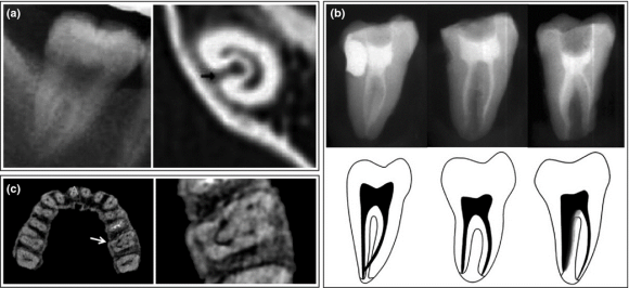 [신경치료] 아래 어금니를 신경치료 할 때 치료할 때 알아야 할 것 (C형근관,고난이도치료) 관련 이미지 5