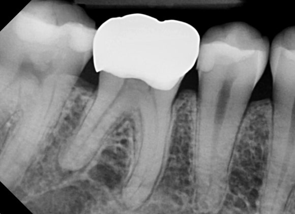 [신경치료] 예전에 크라운을 씌운 치아인데 갑자기 시려졌어요. 관련 이미지 4