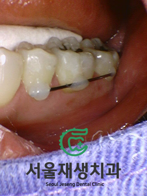 치과에서 치료하는 치아가 아닌 반대편 치아를 갈아내는 이유는? 장기 치료에 반드시 필요한 "정출방지 치아고정"에 대해 알아봅시다. 관련 이미지 12