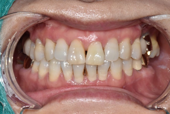 치아가 변색되면 무조건 크라운을 해야 하나요? (치아 미백, 실활치 미백, 신경치료 후 미백, 신촌치과추천,서울재생치과) 관련 이미지 7