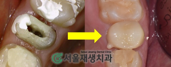 [재신경치료] 다른 치과에서 빼라고 했는데...혹시 살릴 수는 없을까요? (현미경 신경치료, 서울재생치과) 관련 이미지 11