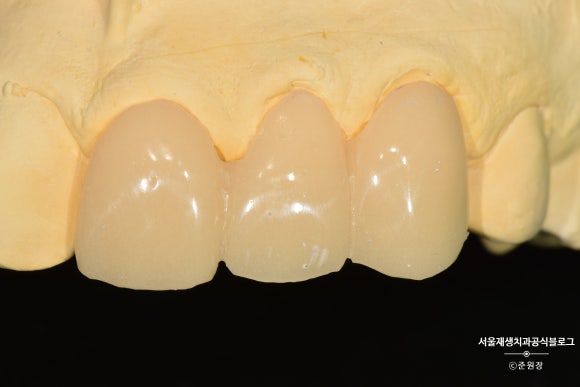 [치아외상] 부러진 앞니, 발치가 답인가요? (사고로 부러진 치아, 외과적정출술로 살리기) 관련 이미지 23