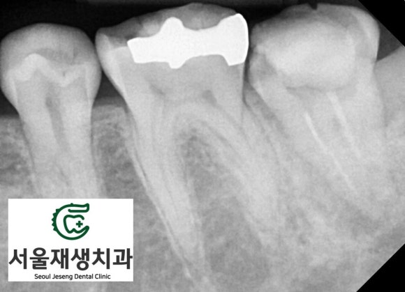 [재신경치료] 예전에 신경치료 받은 치아가 갑자기 너무 아파요! (서울재생치과, 현미경신경치료) 관련 이미지 4
