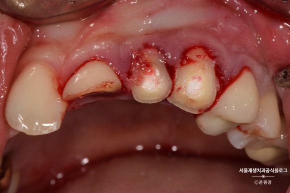 [치아외상] 부러진 앞니, 발치가 답인가요? (사고로 부러진 치아, 외과적정출술로 살리기) 관련 이미지 12