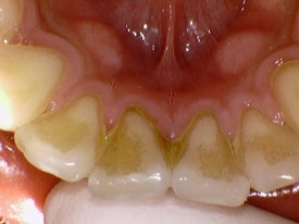 스케일링, 1년에 한 번만 보험이 되나요? 보험스케일링 수시로 받는 법 (건강보험적용 치과치료) 관련 이미지 4