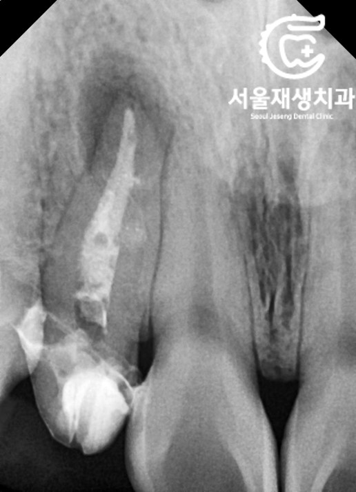 [재신경치료] 소중한 내 앞니...재신경치료로 다시 한 번 살려 쓸 수 있습니다. (서울재생치과, 현미경신경치료) 관련 이미지 7