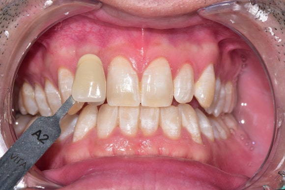 치과에서 미백치료를 받은 후에 치아에 하얀 반점이 생기고 얼룩덜룩해졌어요. 관련 이미지 6