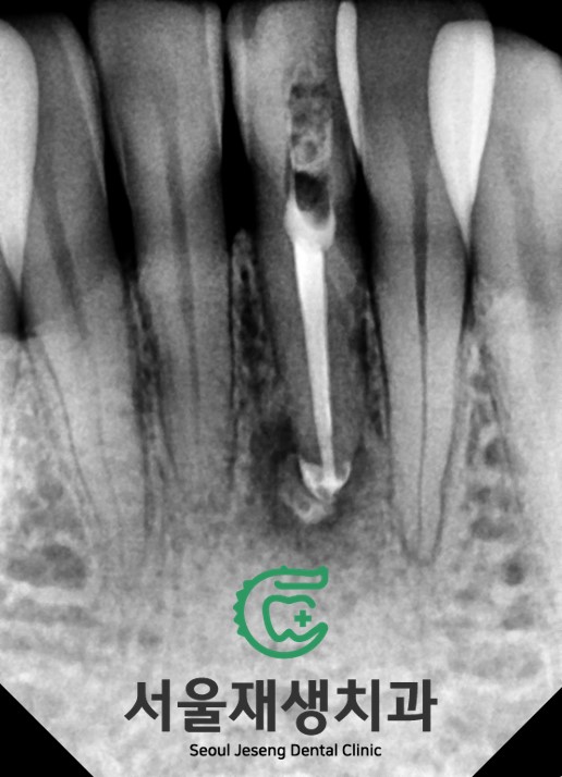 [치아미백] 예전에 부딪힌 앞니가 까맣게 변했어요. 신경이 죽은 치아를 하얗게 돌려놓기! (서울재생치과) 관련 이미지 6