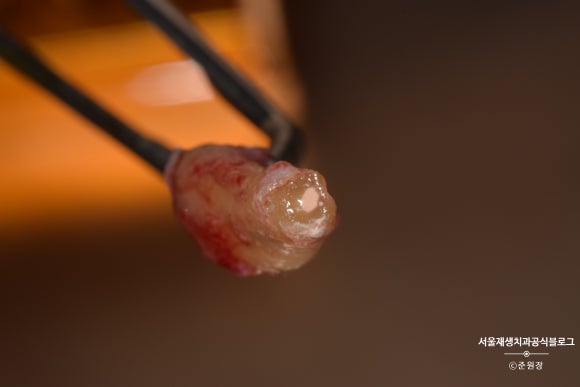 충치나 파절로 짧아진 치아도 다시 보자! (의도적 재식술/치아정출술 후 브릿지치료) 관련 이미지 4