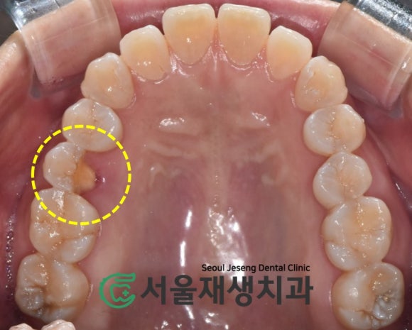 [치아파절] 밥 먹다가 이가 반으로 쪼개졌어요....이런 치아도 살릴 수 있나요? (깨진 치아 치료하기, 신촌 서울재생치과) 관련 이미지 4