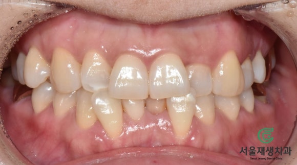 [치아미백] 예전에 부딪힌 앞니가 까맣게 변했어요. 신경이 죽은 치아를 하얗게 돌려놓기! (서울재생치과) 관련 이미지 2