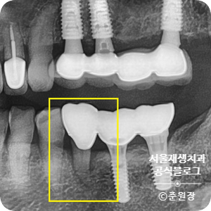 [턱관절] 임플란트 맞은 편 치아가 아파요! (외상성교합, 강한 교합력, 보톡스 치료,턱관절물리치료, 치과 보험진료) 관련 이미지 3