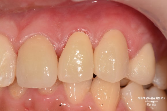 [치아외상] 부러진 앞니, 발치가 답인가요? (사고로 부러진 치아, 외과적정출술로 살리기) 관련 이미지 27