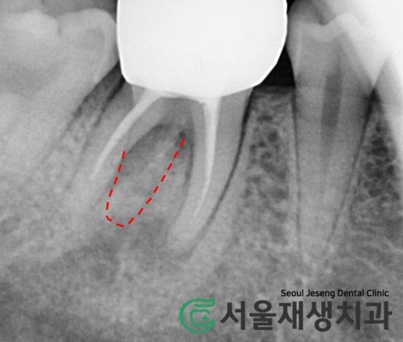 [재신경치료] 신경치료 받은 치아가 붓고 아파요! 현미경과 CT의 도움으로 다시 한 번 꼼꼼하게~ 관련 이미지 6