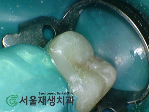 [MTA충치치료] 충치가 클 때.. 신경치료 안하고 치료하는 법 (치수복조술, 신촌 서울재생치과) 관련 이미지 12