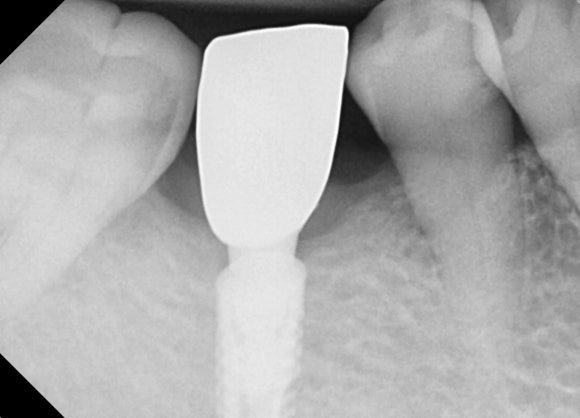 [임플란트] 이가 빠진지 오래되서 옆 치아들이 쓰러졌어요. 임플란트 가능할까요? 네, 가능합니다.1mm의 정교함으로! 관련 이미지 9