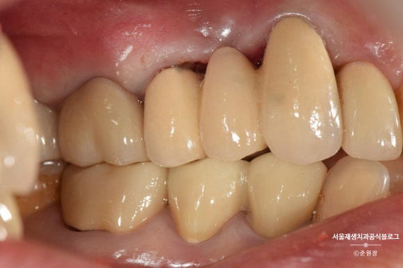 충치나 파절로 짧아진 치아도 다시 보자! (의도적 재식술/치아정출술 후 브릿지치료) 관련 이미지 13