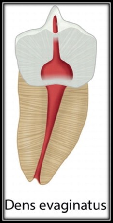 [치외치신경치료] 뿌리 끝 염증이 커서 발치해야된대요! 치아 머리에 볼~록! 알고보면 무서운 작은 혹 (서울재생치과) 관련 이미지 7