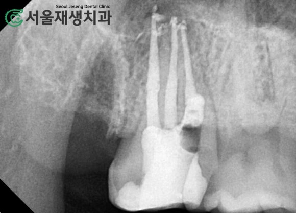 [재신경치료] 엑스레이를 찍었더니 치아 뿌리 염증이 보인대요! (현미경 신경치료, 서울재생치과) 관련 이미지 7