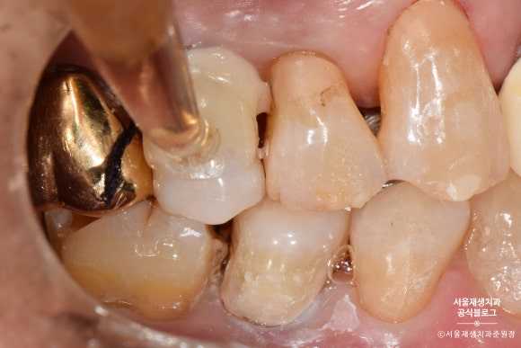잇몸 패임, 무슨 재료로 때우나요? 레진과 글라스아이오노머(GI)로 치경부마모증 치료하기 (서울재생치과,신촌치과) 관련 이미지 23