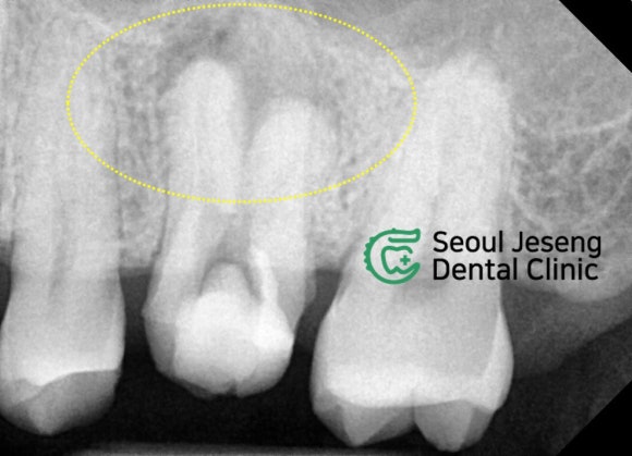 [재신경치료] 재신경치료까지 했는데 계속 아파요..미세 현미경을 이용한 세번째 신경치료! (서울재생치과) 관련 이미지 4