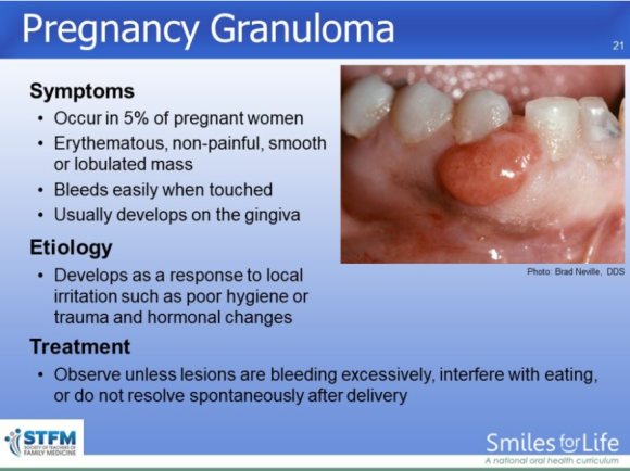 임신 중 치은염&middot;치주염&middot;시린이 증상, 이렇게 관리하세요! (임산부 잇몸관리) 관련 이미지 3