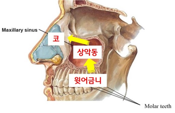윗 어금니 신경치료 후에 코피가 나요 (신경치료 후 주의사항, 상악동, 신촌 서울재생치과, 신촌 신경치료 맛집, 현미경 신경치료) 관련 이미지 4
