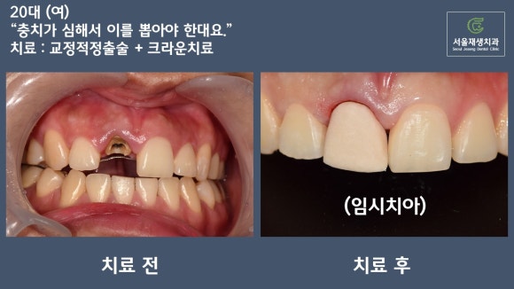 [치료사례] 뿌리만 남은 치아의 마지막 치료, 교정적 치아정출술 관련 이미지 2
