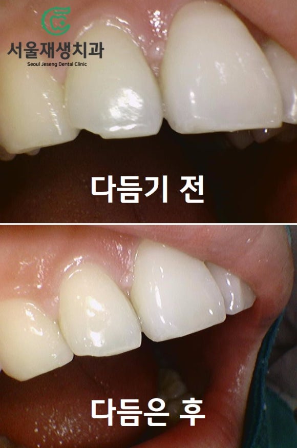 [깨진앞니치료] 살짝 다듬고, 살짝 때우고! (서울재생치과 신촌) 관련 이미지 8