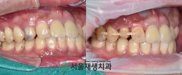 [치아정출술] 충치가 뿌리까지 진행되서 발치해야 한대요...뿌리 깊은 충치도 살려내기 (서울재생치과) 관련 이미지 11
