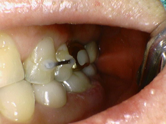 [임플란트] 재신경치료를 시도할 수 없을 때. 뼈이식 없는 임플란트 시술로 간편하게. 관련 이미지 4