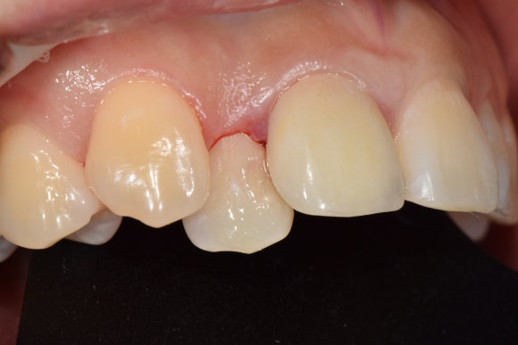 [치료사례] 덧니에 생긴 충치 어떻게 치료하나요? (신촌치과, 충치치료, 레진치료) 관련 이미지 5