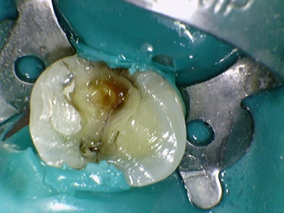 A Tooth Filled with Amalgam Long Ago Has Cracked. image 4