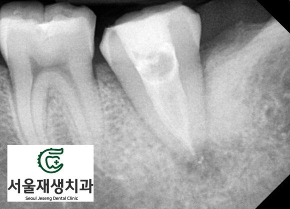 [재신경치료] 치과 종사자도 찾아오는 신경치료 전문치과, 서울재생치과! 관련 이미지 8