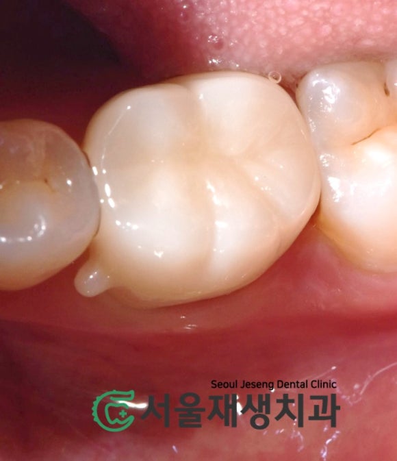 [재신경치료] 신경치료 받은 치아가 붓고 아파요! 현미경과 CT의 도움으로 다시 한 번 꼼꼼하게~ 관련 이미지 18
