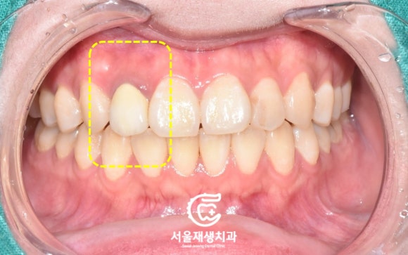 [재신경치료] 소중한 내 앞니...재신경치료로 다시 한 번 살려 쓸 수 있습니다. (서울재생치과, 현미경신경치료) 관련 이미지 4