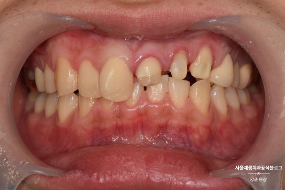 [치아외상] 부러진 앞니, 발치가 답인가요? (사고로 부러진 치아, 외과적정출술로 살리기) 관련 이미지 26