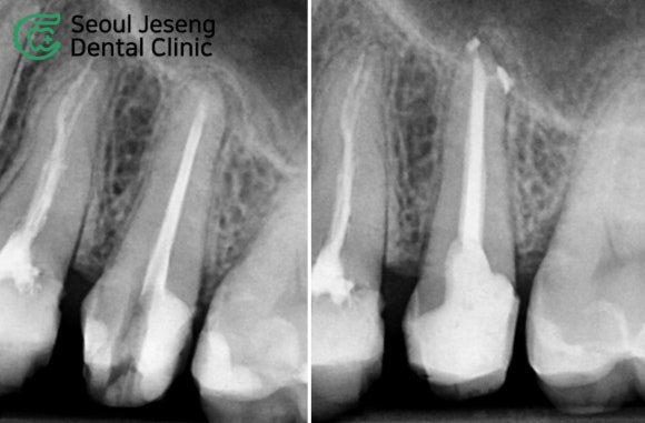 [치료사례] 재신경치료 (6) 관련 이미지 1
