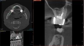 [재신경치료] 10년전에 한 신경치료가 뭔가 불편해요... 관련 이미지 10